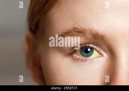 Frau mit gelben Augen auf verschwommenem Hintergrund, Nahaufnahme. Symptom der Hepatitis Stockfoto