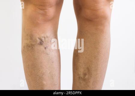 Vor Nach Cellulite Entzündung Beine Behandlung Closeup Stockfoto