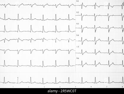 Herzfrequenz auf Papier zur Aufzeichnung eines Elektrokardiogramms, Prävention von Herzkrankheiten. Elektrokardiogramm-Streifen mit Herzrhythmusstörungen. Optionen Stockfoto