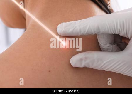 Entfernung des Leberflecks durch Laser. Arzt prüft die Haut des Patienten während des Eingriffs in der Klinik, Nahaufnahme Stockfoto