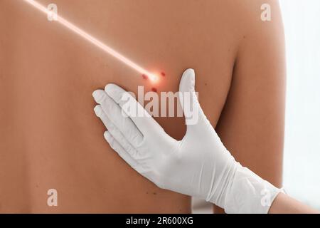 Entfernung des Leberflecks durch Laser. Arzt überprüft die Haut des Patienten während des Eingriffs auf weißem Hintergrund, Nahaufnahme Stockfoto