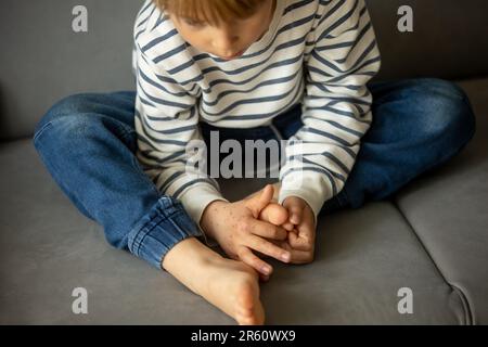 Kind mit Hautausschlag, Roseola, Hand-Fuss-und-Klauenseuche, Kind-Hautausschlag-Krankheit Stockfoto