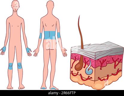 Illustration der Hautkrankheit psoriasis Stock Vektor