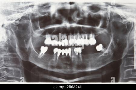 Panorama-Röntgenaufnahmen der Mundhöhle. Zahnärztliche Behandlung. Radiologie Stockfoto