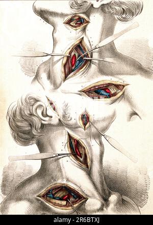 Medizin, Anatomie, Chirurgie der Karotiden und der Subklavien, zwei Abbildungen zeigen Abschnitte von Kopf und Hals, mit chirurgischen Instrumenten zur Anzeige der Arterien, circa 1834, historische, digital restaurierte Reproduktion aus einem Original aus dem 19. Jahrhundert / Medizin, Anatomie, Chirurgie der Arteria carotis und Subclavia, Zwei Abbildungen mit Schnitten in Kopf und Hals, mit chirurgischen Instrumenten, die Arterien anzeigen, um 1834, Historisch, digital restaurierte Reproduktion von einer Vorlage aus dem 19. Hundert Stockfoto