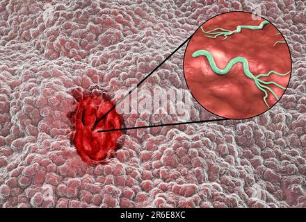 Magengeschwür und Nahaufnahme des Bakteriums Helicobacter pylori, Illustration. Magengeschwüre oder peptische Geschwüre sind Erosionen des Schleimhautlinins Stockfoto