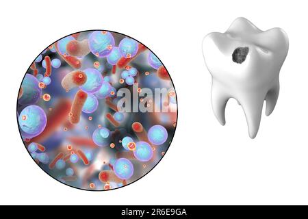 Zahnverfall. Computerdarstellung eines Zahnes mit Kavität und Nahaufnahme kariesbildender Bakterien. Stockfoto