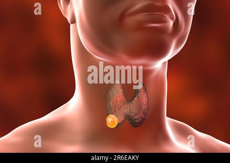 Tumor in der menschlichen Schilddrüse, Computerdarstellung. Stockfoto