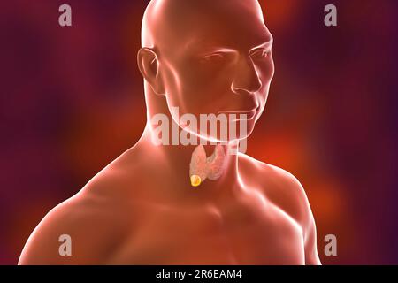 Tumor in der menschlichen Schilddrüse, Computerdarstellung. Stockfoto