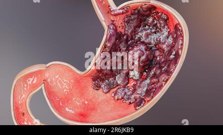 Magenkrebs. Stadien des Tumorwachstums im Verdauungssystem, peptisches Ulkus, Krebs attackierende Zelle. Magenkrankheitskonzept. Symptome, bösartige Krebserkrankungen, Stockfoto