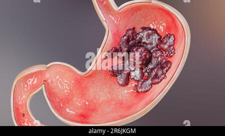 Magenkrebs. Stadien des Tumorwachstums im Verdauungssystem, peptisches Ulkus, Krebs attackierende Zelle. Magenkrankheitskonzept. Symptome, bösartige Krebserkrankungen, Stockfoto