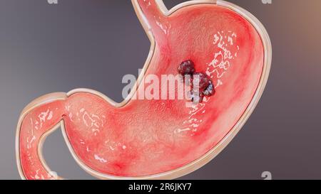 Magenkrebs. Stadien des Tumorwachstums im Verdauungssystem, peptisches Ulkus, Krebs attackierende Zelle. Magenkrankheitskonzept. Symptome, bösartige Krebserkrankungen, Stockfoto