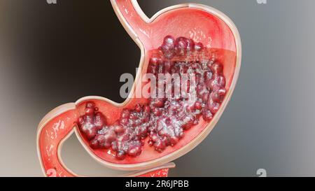 Magenkrebs. Stadien des Tumorwachstums im Verdauungssystem, peptisches Ulkus, Krebs attackierende Zelle. Magenkrankheitskonzept. Symptome, bösartige Krebserkrankungen, Stockfoto