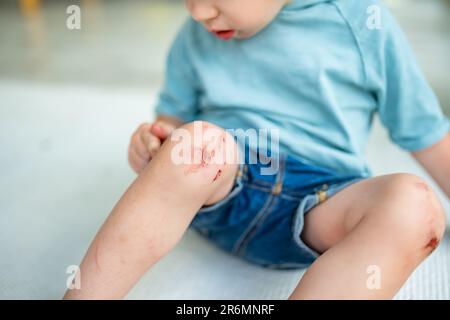 Ein kleiner Junge mit schmerzenden Kniescheiben. Eltern helfen ihrem Kind, eine erste-Hilfe-Knieverletzung durchzuführen, nachdem es einen Unfall hatte. Stockfoto