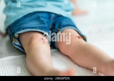 Ein kleiner Junge mit schmerzenden Kniescheiben. Eltern helfen ihrem Kind, eine erste-Hilfe-Knieverletzung durchzuführen, nachdem es einen Unfall hatte. Stockfoto