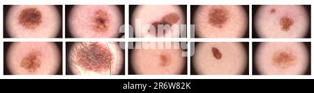 Komplexer melanozytärer Naevus. Dermatoskopie der Haut. Makrovergrößerung mit einem Dermatoskop-Mikroskop um das 20-fache. Eine Reihe verschiedener Nävus. Untersuchung durch einen Dermatologen. Muttermal des Maulwurfs - Nahaufnahme. Stockfoto