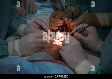 Operation zum Nähen des Handgelenks. Das Team aus Neurochirurgen und Traumatologen stellt die Hand wieder her. Operation zur Nähung von Nerven und Sehnen am Handgelenk. Stockfoto