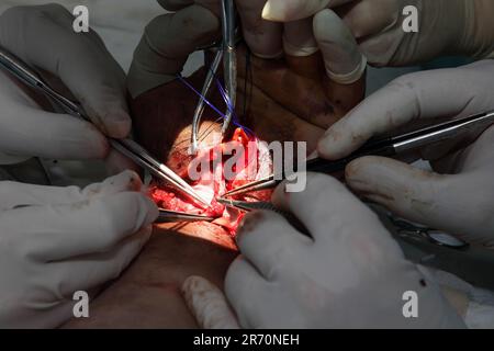 Operation zum Nähen des Handgelenks. Das Team aus Neurochirurgen und Traumatologen stellt die Hand wieder her. Operation zur Nähung von Nerven und Sehnen am Handgelenk. Stockfoto