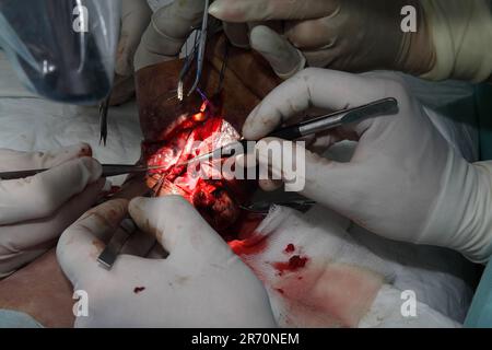 Operation zum Nähen des Handgelenks. Das Team aus Neurochirurgen und Traumatologen stellt die Hand wieder her. Operation zur Nähung von Nerven und Sehnen am Handgelenk. Stockfoto