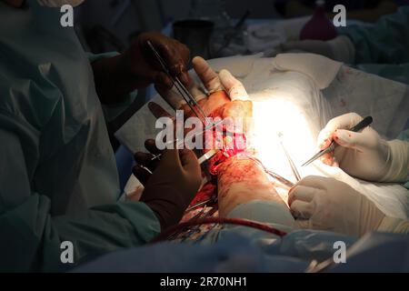 Operation zum Nähen des Handgelenks. Das Team aus Neurochirurgen und Traumatologen stellt die Hand wieder her. Operation zur Nähung von Nerven und Sehnen am Handgelenk. Stockfoto