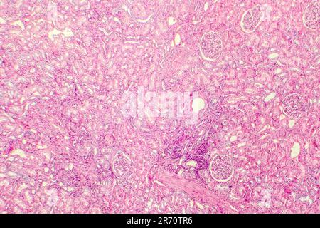 Hyaline Nierenarteriendegeneration, Lichtmikrograph Stockfoto