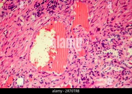 Hyaline Nierenarteriendegeneration, Lichtmikrograph Stockfoto