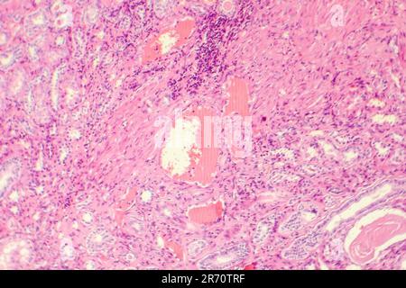 Hyaline Nierenarteriendegeneration, Lichtmikrograph Stockfoto