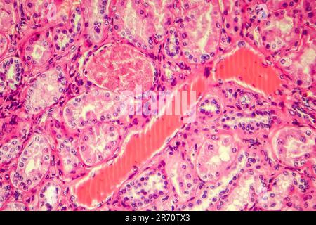 Hyaline Nierenarteriendegeneration, Lichtmikrograph Stockfoto