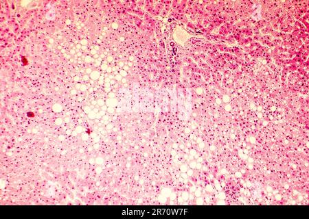 Fettleber, Lebersteatose. Photomikrograph zeigt große Vakuolen von Triglyceridfett, das sich in Leberzellen angesammelt hat, tritt es bei Alkoholüberverbrauch auf, Stockfoto