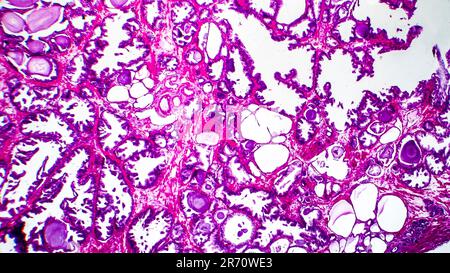 Histopathologie der Prostatahyperplasie, Lichtmikrographen, Foto unter dem Mikroskop Stockfoto