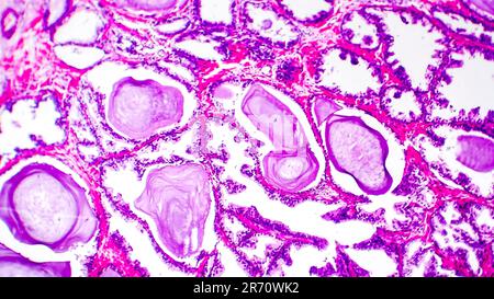 Histopathologie der Prostatahyperplasie, Lichtmikrographen, Foto unter dem Mikroskop Stockfoto