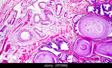 Histopathologie der Prostatahyperplasie, Lichtmikrographen, Foto unter dem Mikroskop Stockfoto