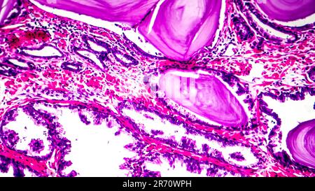 Histopathologie der Prostatahyperplasie, Lichtmikrographen, Foto unter dem Mikroskop Stockfoto