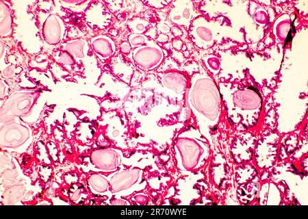 Prostatahyperplasie. Photomikrogramm mit Drüsenerweiterung, Umhüllung der Drüsenepithelzellen, die papilläre Projektionen in die Drüse bilden Stockfoto