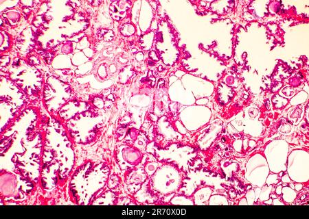 Prostatahyperplasie. Photomikrogramm mit Drüsenerweiterung, Umhüllung der Drüsenepithelzellen, die papilläre Projektionen in die Drüse bilden Stockfoto