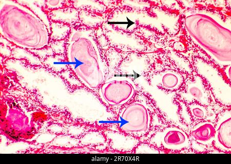 Prostatahyperplasie. Photomikrogramm mit Drüsen-Erweiterung, Papillenvorsprüngen in den Drüsen Lumen, schwarzen Pfeilen, zystischer Dilatation mit gemäß Stockfoto