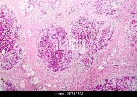 Akute hämorrhagische Pankreatitis, Licht Schliffbild, Hämatoxylin und Eosin färben Stockfoto