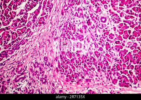 Akute hämorrhagische Pankreatitis, Licht Schliffbild, Hämatoxylin und Eosin färben Stockfoto