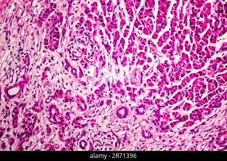 Akute hämorrhagische Pankreatitis, Licht Schliffbild, Hämatoxylin und Eosin färben Stockfoto