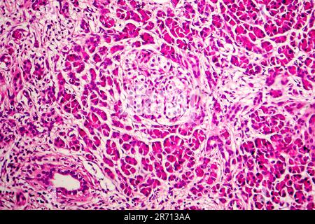 Akute hämorrhagische Pankreatitis, Licht Schliffbild, Hämatoxylin und Eosin färben Stockfoto