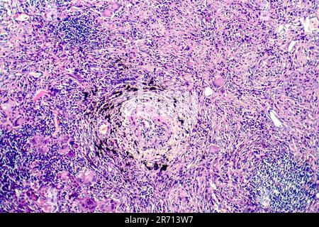 Histopathologie der Tuberkulose, Lichtmikroskopie der Tuberkuloseschädigung, Foto unter dem Mikroskop Stockfoto