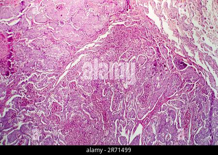 Lungen-Adenokarzinom, Lichtmikroskop, Foto unter dem Mikroskop Stockfoto