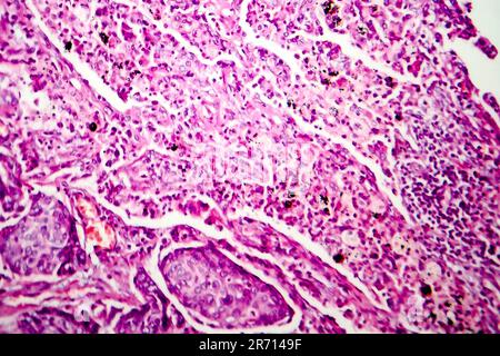 Lungen-Adenokarzinom, Lichtmikroskop, Foto unter dem Mikroskop Stockfoto