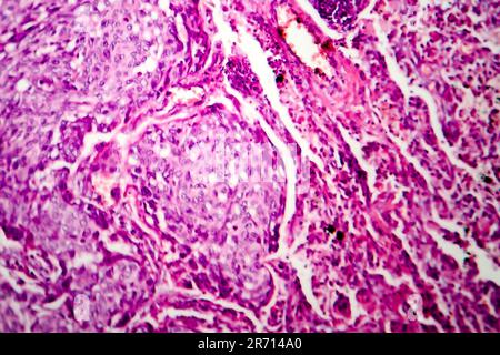 Lungen-Adenokarzinom, Lichtmikroskop, Foto unter dem Mikroskop Stockfoto