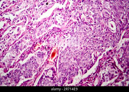 Lungen-Adenokarzinom, Lichtmikroskop, Foto unter dem Mikroskop Stockfoto