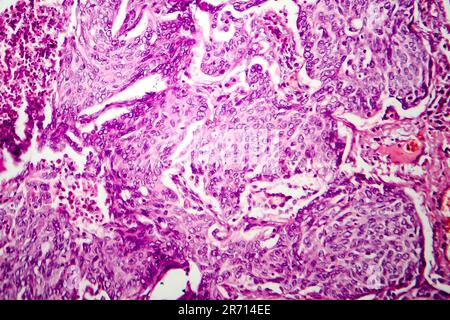 Lungen-Adenokarzinom, Lichtmikroskop, Foto unter dem Mikroskop Stockfoto