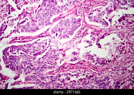 Lungen-Adenokarzinom, Lichtmikroskop, Foto unter dem Mikroskop Stockfoto