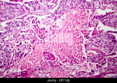 Lungen-Adenokarzinom, Lichtmikroskop, Foto unter dem Mikroskop Stockfoto
