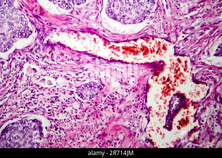 Lungen-Adenokarzinom, Lichtmikroskop, Foto unter dem Mikroskop Stockfoto
