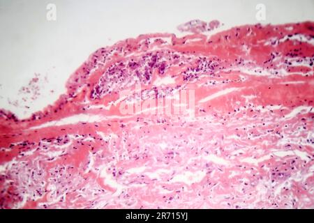 Histopathologie der tuberkulösen Pleuritis, Lichtmikrographen, Lichtbild unter dem Mikroskop Stockfoto